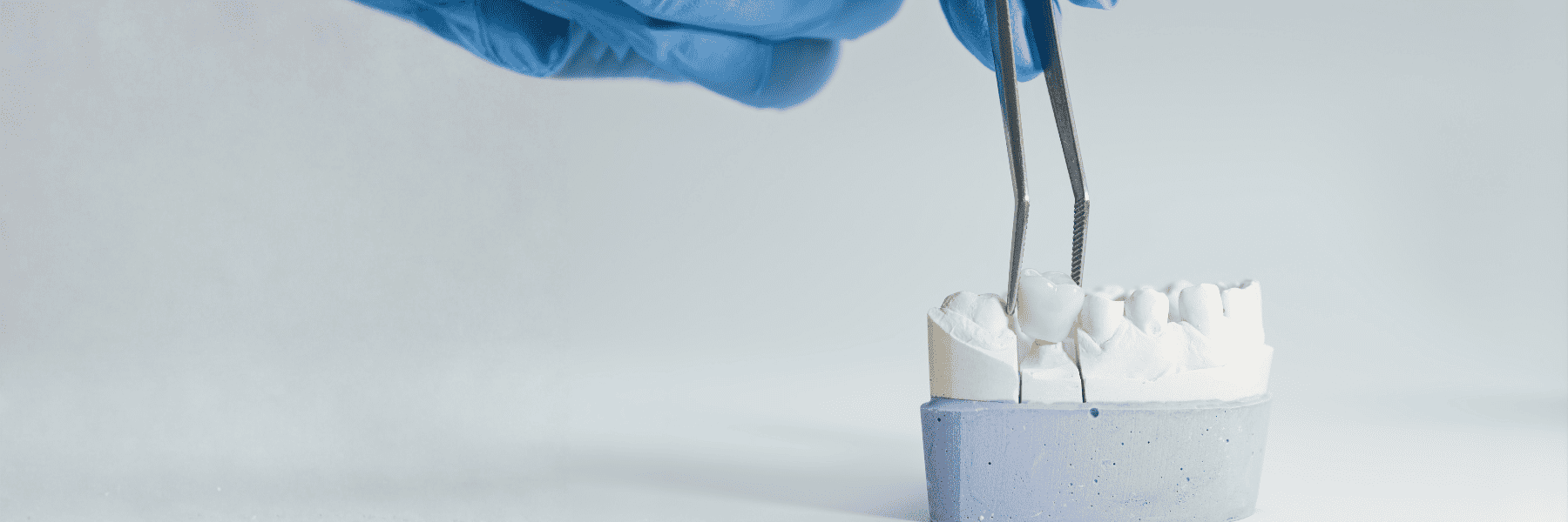 Implant-Supported Crowns and Bridges | Dentist