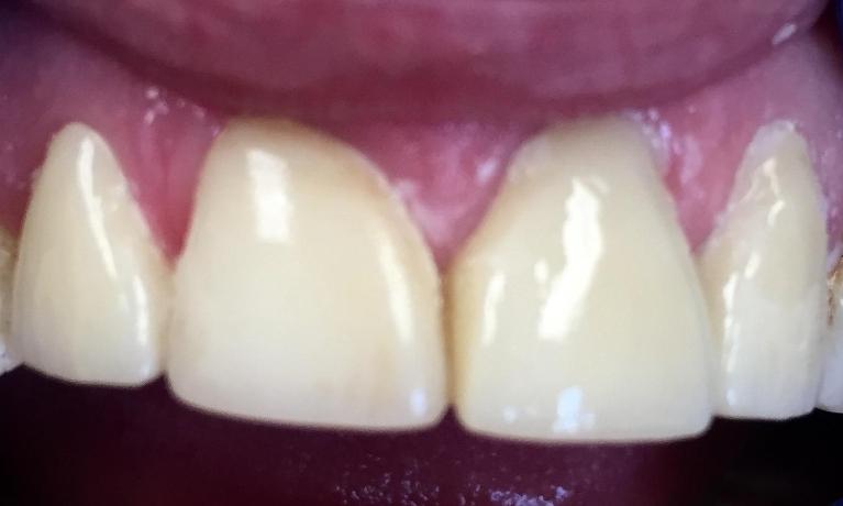All-ceramic-crowns-After-Image