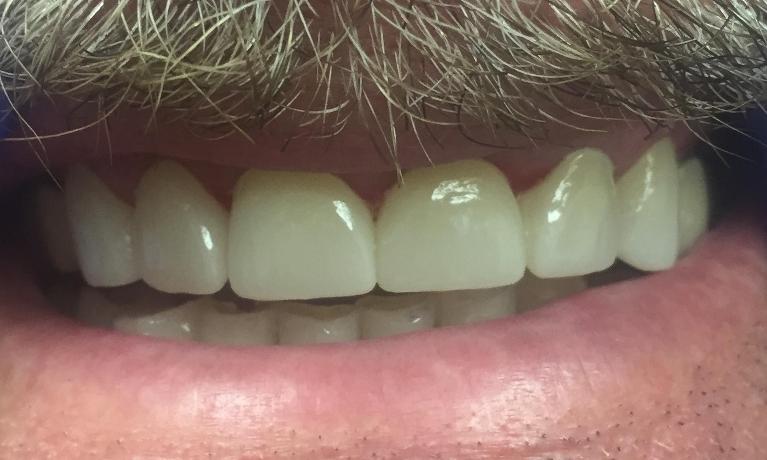 Anterior-Crowns-After-Image