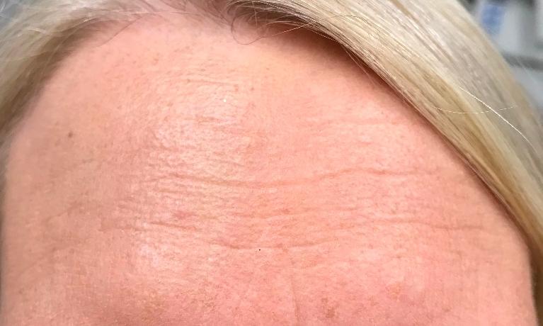 Botox-Treatment-After-Image