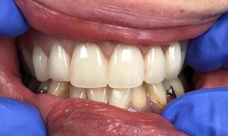 New-upper-denture-After-Image