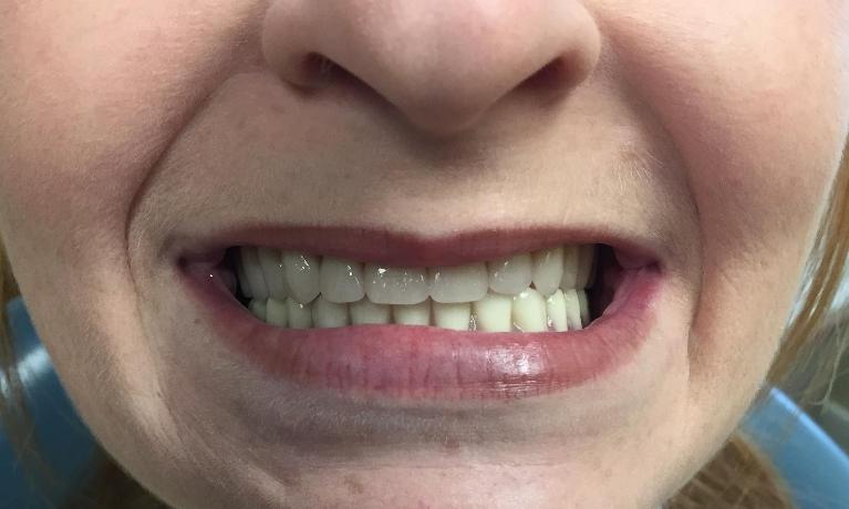 Replacing-an-old-denture-After-Image