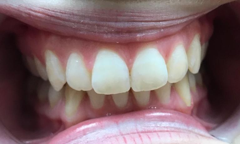 Straighter-teeth-After-Image
