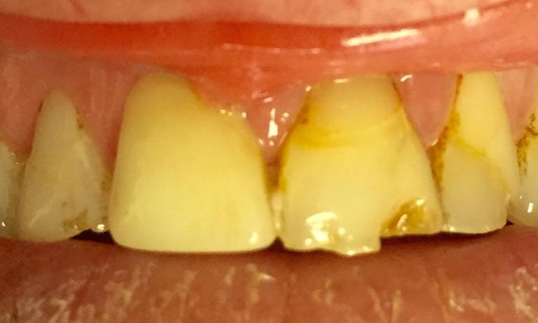 All-ceramic-crowns-Before-Image