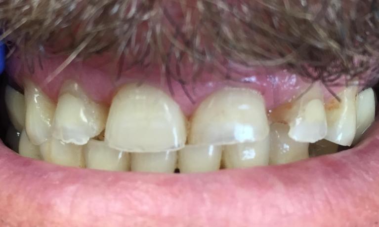 Anterior-Crowns-Before-Image