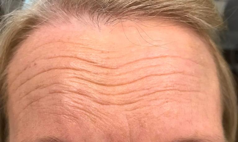 Botox-Treatment-Before-Image