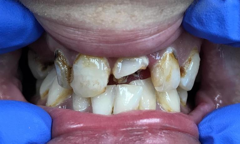 New-upper-denture-Before-Image