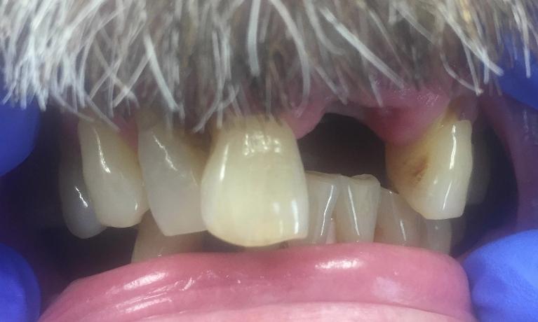 New-upper-partial-denture-Before-Image