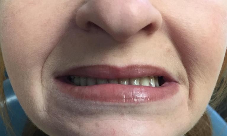 Replacing-an-old-denture-Before-Image
