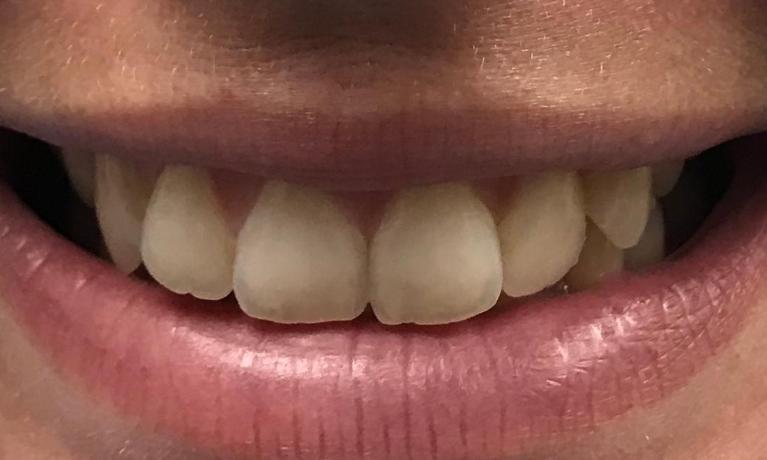 Straighter-teeth-Before-Image
